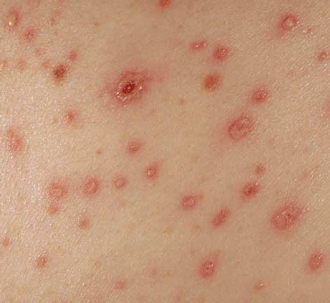 Fungal Rash - Causes, Symptoms, Treatment, Pictures, Infection | Health9