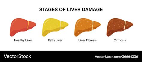 Stages nonalcoholic liver damage healthy Vector Image