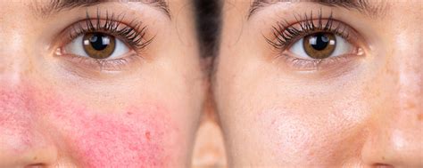 Rosacea Vs Lupus Butterfly Rash