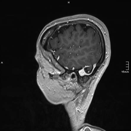 Brain herniation into giant arachnoid granulation of the sigmoid sinus | Radiology Case ...