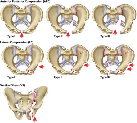 Pelvic Fractures - Physiopedia