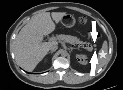 Transverse CT scan of accessory spleen at pancreatic tail. Accessory... | Download Scientific ...