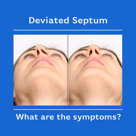 Deviated Septum — ENT & Allergy, Inc