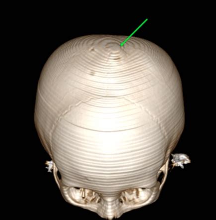 Arachnoid granulation | Radiology Case | Radiopaedia.org