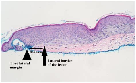 Compound Nevus With Mild Atypia