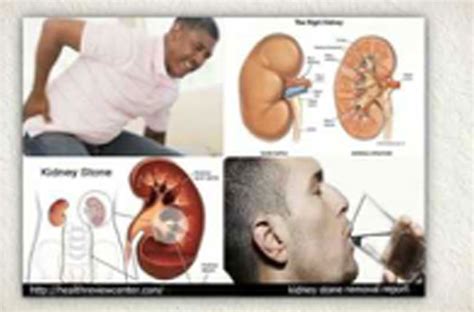 Uric Acid Kidney Stones