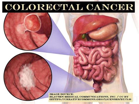 Colorectal Cancer Symptoms