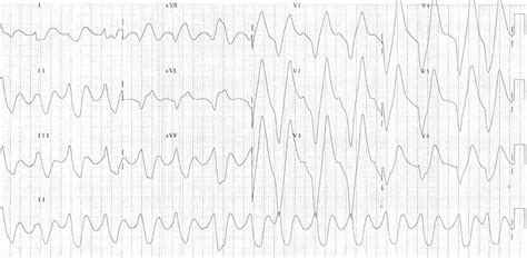 Hyperkalemia Ekg