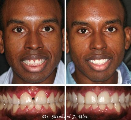 Teeth Veneers Before And After