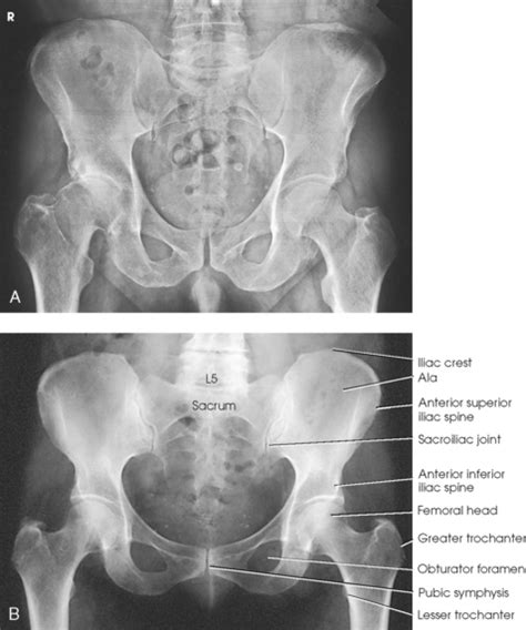 Anterior Superior Iliac Spine X Ray