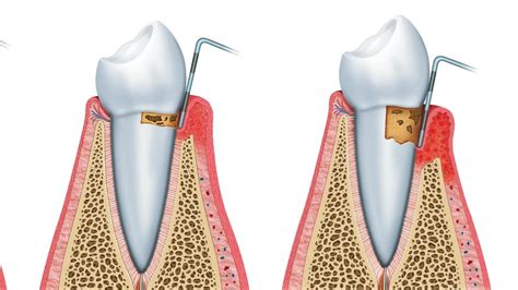 Gingivitis vs. Periodontitis - Four Stages of Gum Disease | Periodontal Disease Treatment Houston TX