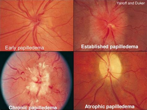 Optociliary Shunt Vessels — Ophthalmology Review