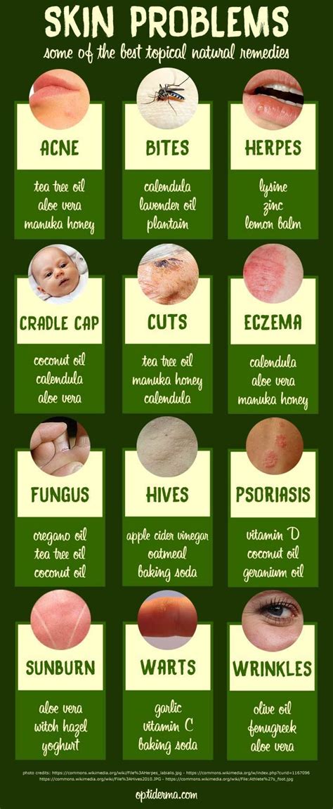 Natural Remedies for Skin Problems - Infographic.... Take a look at more by visiting the photo ...