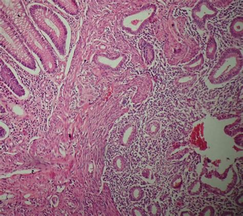 (a) Tomography revealing a cecum mass with complete bowel obstruction.... | Download Scientific ...