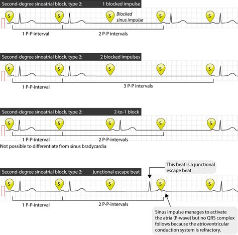 Sinoatrial block (SA block): ECG criteria, causes and clinical features ...