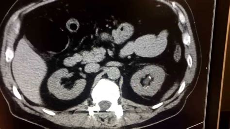 CT scan for kidney stone | FunnyCat.TV