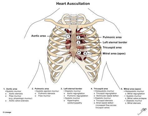 Aortic Stenosis Murmur