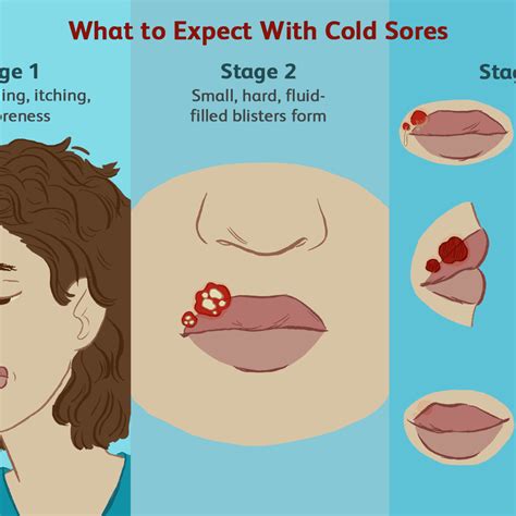 Cold Sore And Swelling Lips | Sitelip.org