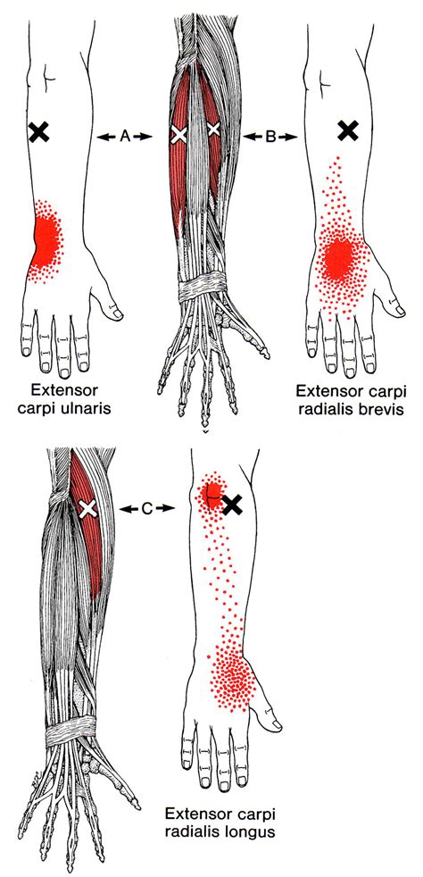 Extensor Carpi Ulnaris | The Trigger Point & Referred Pain Guide