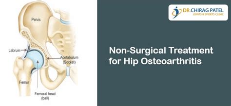 Non-Surgical Treatment for Hip Osteoarthritis - Dr Chirag