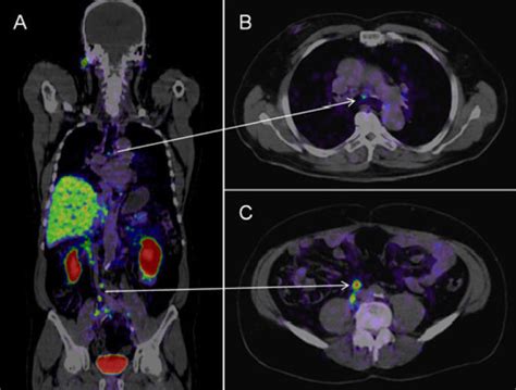 PSMA PET-CT Accurately Detects Prostate Cancer Spread (2024)