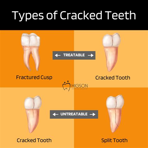 Cracked Tooth Repair - Common Causes and Fixes For Cracked Teeth | Emergency Dentist Offering ...