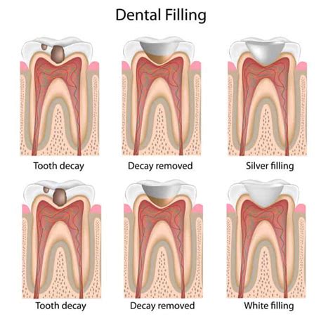 Tooth Colored Filling McDonough GA - Family Dentistry