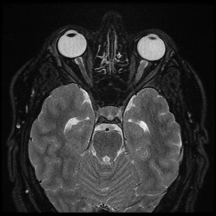 Optic Neuritis