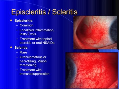 scleritis - DriverLayer Search Engine