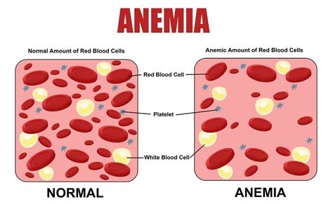 Iron Deficiency Anemia Symptoms