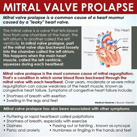 Mitral valve prolapse – Artofit