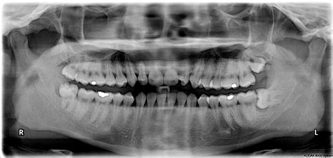 Dental Extractions and Wisdom Teeth | Seven Hills Dentist | Capstone Dental