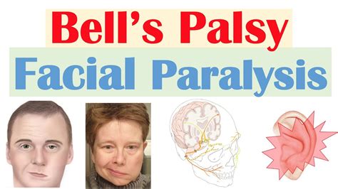 Bell’s Palsy (Facial Paralysis) | Causes, Pathophysiology, Signs ...