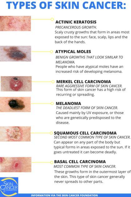 types of skin cancer - Fromadietitianserpective