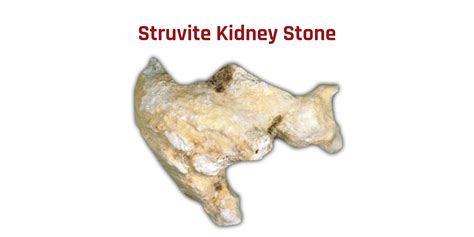 Struvite Kidney Stones: The Bacteria-Based Stone | Stone Relief