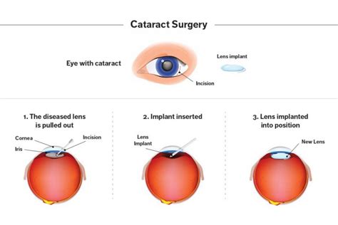 EVERYTHING YOU NEED TO KNOW ABOUT CATARACT! - OPHTHALMOLOGY