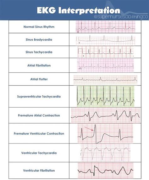 Understanding Ecg Results