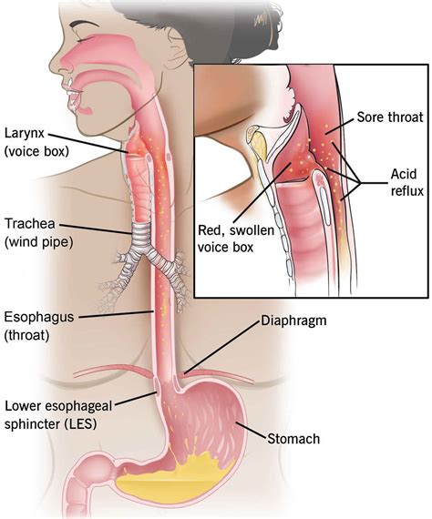 Esophageal stricture causes, symptoms, diagnosis, treatment & prognosis