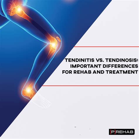 Tendinitis Exercises and Understanding Different Tendon Injuries