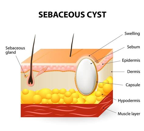 When Are Sebaceous Cysts Cause for Concern?: Lakeland Surgical Clinic, PLLC: General Surgery and ...