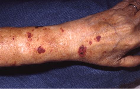 Causes of senile purpura - Information and symptoms of senile bleeding ...