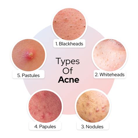 Acne Types And Treatment