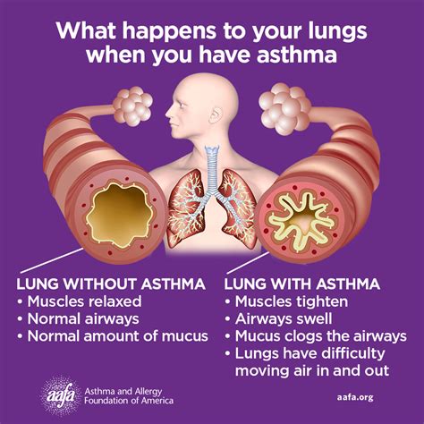 What Are Asthma Symptoms?