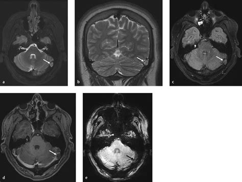 2 Arachnoid Granulations | Radiology Key