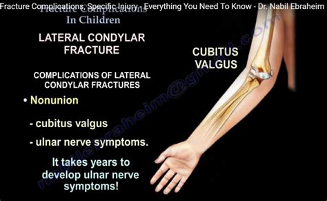 Fracture complications in children — OrthopaedicPrinciples.com