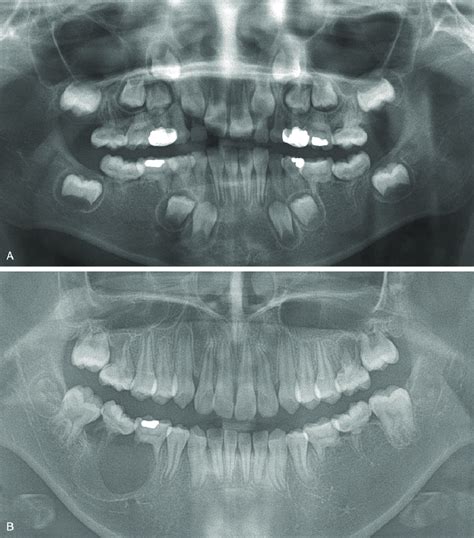 (A) Panoramic radiograph and intraoral periapical radiographs of... | Download Scientific Diagram