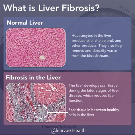 3 Charts | What is NASH Fibrosis? | A Visual Guide