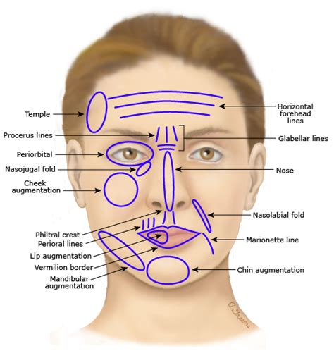 Soft tissue fillers - Heleia Nestal Zibo