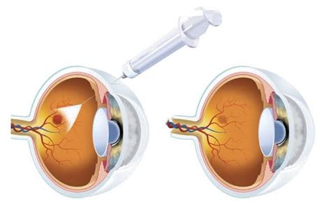 Anti-VEGF: Treatment for Wet AMD - Eye Care - The Eye News