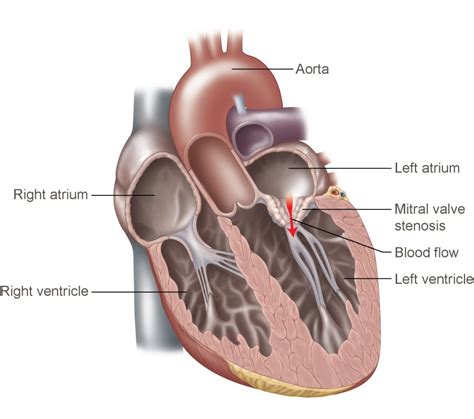 Mitral Valve Stenosis | Temple Health